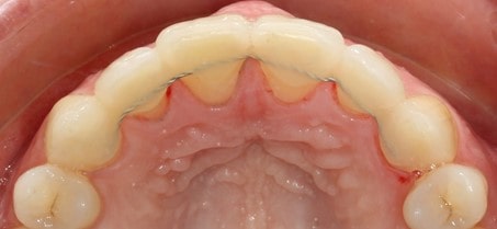 Contention Orthodontique Maxillaire