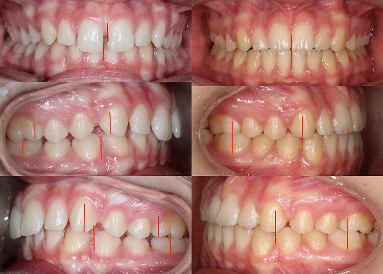 Traitement Multi-Bagues Orthodontique